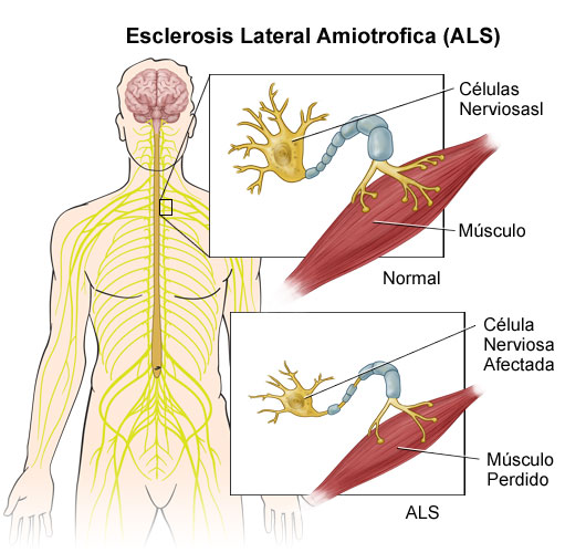 21 de junio – Día Mundial Contra la ELA (Esclerosis Lateral Amiotrócica)