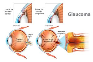 Read more about the article GLAUCOMA